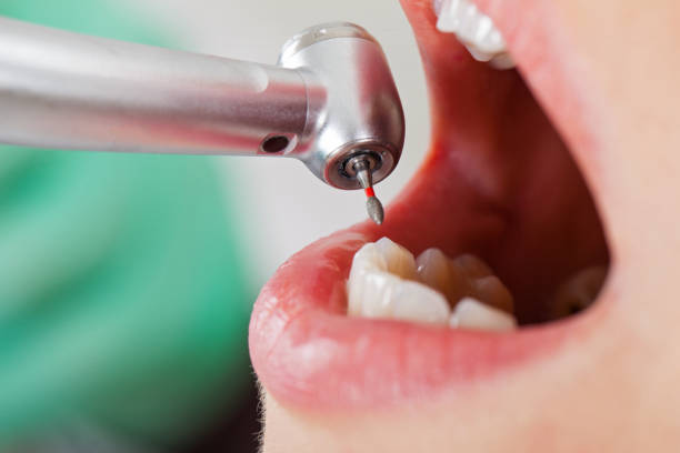 Best Emergency Wisdom Teeth Removal in Timberlake, VA